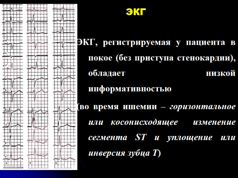 ЭКГ ЭКГ, регистрируемая у пациента в покое (без приступа стенокардии), обладает низкой информативностью 